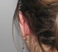 Operazione orecchie (Otoplastica) - Foto del prima - Dott. Ranieri Mazzei