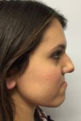 Rinoplastica - Paziente affetta da alterazione di sviluppo del terzo medio ed inferiore del volto. Intervento chirurgico di Le Fort I, BSSO, genioplastica e settorinoplastica funzionale.