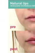 Aumento labbra - Foto del prima - Visage Medicina e Chirurgia Estetica