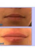 Aumento labbra - Foto del prima - Dr. Massimo Dolcet
