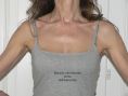 Lifting delle braccia - La pelle flaccida e in eccesso delle braccia si può togliere e la cicatrice è quasi invisibile.