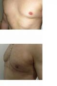Lipofilling al seno - Foto del prima - Dr Uberto Giovannini