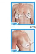 Lipofilling al seno - Foto del prima - Dr. Pietro Loschi