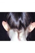 Operazione orecchie (Otoplastica) - Foto del prima - Dott. NICOLA CATANIA