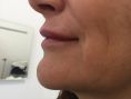 Aumento labbra - Sono state iniettate 3 fiale di acido ialuronico dedicato lips in 4 mesi per ottenere il risultato finale con piena soddisfazione della paziente.