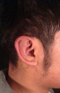 Operazione orecchie (Otoplastica) - Foto del prima - Dr. Luigi Maria Lapalorcia Specialista in Chirurgia Plastica Ricostruttiva ed Estetica