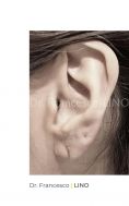 Operazione orecchie (Otoplastica) - Foto del prima - Dott. Francesco Lino