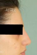 Rinoplastica non chirurgica - Rimodellamento del naso senza chirurgia