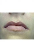 Aumento labbra - Foto del prima - Dott. Carlo Lampignani
