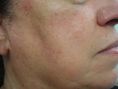 Procedure laser in dermatologia estetica  - Le cheratosi seborroica è una forma tumorale benigna  che interessa la pelle, è localizzata prevalentemente sul volto e sul tronco di soggetti in età avanzata.  E