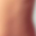 Dott. Egidio Riggio - - età 30-39, corporatura magra, torace lungo con cicatrici da mastopessi verticale e additiva sottoghiandolare (eseguito anni prima da altro chirurgo) 
- sostituzione di protesi rotte, rotonde da 240cc, con protesi anatomiche 510 MX 445 grammi
- nuova tasca dualplane modficata da riggio
- da seconda a terza misura.