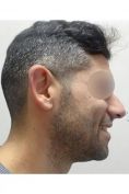Operazione orecchie (Otoplastica) - Foto del prima - Dr. Mario Gioia