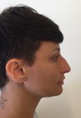 Rinoplastica - Settorinoplastica primaria. Deproiezione della punta e correzione dell’angolo naso-labiale mediante riduzione della spina nasale anteriore. Rotazione e sostegno della punta con columellar strut. Regolarizzazione del dorso nasale.