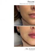 Aumento labbra - Foto del prima - Dott.  Alfredo Colapietra