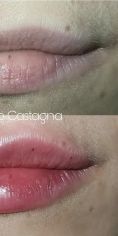 Aumento labbra - Foto del prima - Antonio Castagna