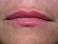 Aumento labbra - Foto del prima - Dott. Alessandro Maria Caboni M.D.