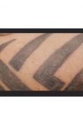 Rimozione tatuaggi - laser - Foto del prima - Dott. Giulio Maria Maggi Chirurgo plastica