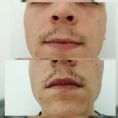 Aumento labbra - Foto del prima - Dott. Hicham Mouallem