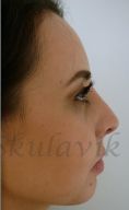 Settoplastica (operazione al setto nasale) - Foto del prima