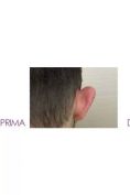 Operazione orecchie (Otoplastica) - Foto del prima - Dott. Massimiliano Sparacello