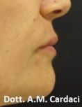 Aumento labbra con Permalip - Foto del prima - Dott. Aurelio M. Cardaci