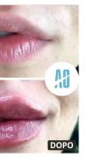 Aumento labbra - Foto del prima - Dott. Alberto Orlandi