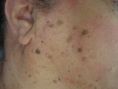 Procedure laser in dermatologia estetica  - Le cheratosi seborroica è una forma tumorale benigna  che interessa la pelle, è localizzata prevalentemente sul volto e sul tronco di soggetti in età avanzata.  E