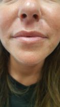 Aumento labbra - Foto del prima - Dott.ssa Carolina Turcan