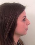 Dott. Tito Marianetti - Rinoplastica primaria. Armonizzazione del dorso e della punta nasale. Definizione dell’angolo naso-labiale con asportazione della spina nasale anteriore.