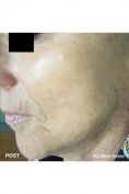 Procedure laser in dermatologia estetica  - Foto del prima - Dott.ssa Sara Russo