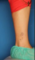 Rimozione tatuaggi - laser - Foto del prima - Cliniche Novagenesis - Dott.  Alberto Rossi Todde