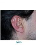 Operazione orecchie (Otoplastica) - Foto del prima - Dott. Angelo  Scioli