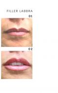 Aumento labbra - Foto del prima - Dott. Francesco Lino