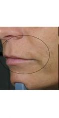 Aumento labbra - Foto del prima - Dott. Giorgio Russo