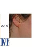 Operazione orecchie (Otoplastica) - Foto del prima - Dott.ssa Marialisa Truccolo M.D.