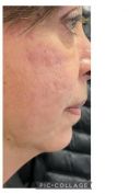 Acne laser, Cicatrici da acne laser - Foto del prima - Dr. Mario Gioia