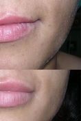Aumento labbra - Foto del prima - Dott.ssa Adriana Pozzi