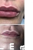 Aumento labbra - Foto del prima - Dott. Luigi Petti
