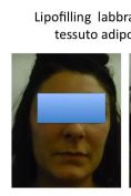 Lipofilling (grasso) - Foto del prima - Dr. Luigi Maria Lapalorcia Specialista in Chirurgia Plastica Ricostruttiva ed Estetica
