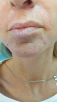 Aumento labbra - Foto del prima - Dott.ssa Carolina Turcan