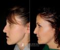 Clinica Estetica Europa - Malocclusione maxillo-mandibolare eseguita dal Dott. Ikenna Valentine Aboh