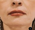 Aumento labbra - Foto del prima - Dr Uberto Giovannini