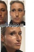 Impianti del viso, Impianti facciali - Foto del prima - Dott. Antonio  Tambuscio M.D.