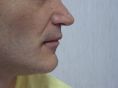 Aumento labbra - Foto del prima - Prof. Roberto  d