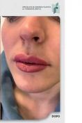 Aumento labbra - Foto del prima - Dott. Fioravante Orefice