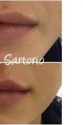 Aumento labbra - Foto del prima - Dott.ssa Cristina Sartorio