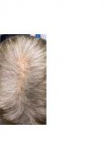 Trapianto capelli - Foto del prima - Dott.ssa Olena Zinchenko
