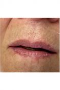 Aumento labbra - Foto del prima -  Meb Medicina estetica e Benessere