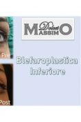 Blefaroplastica - Foto del prima - Dr. Massimo Dolcet
