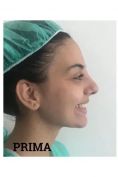 Rinoplastica - Foto del prima - Medical Center Chirurgia Plastica - Cagliari